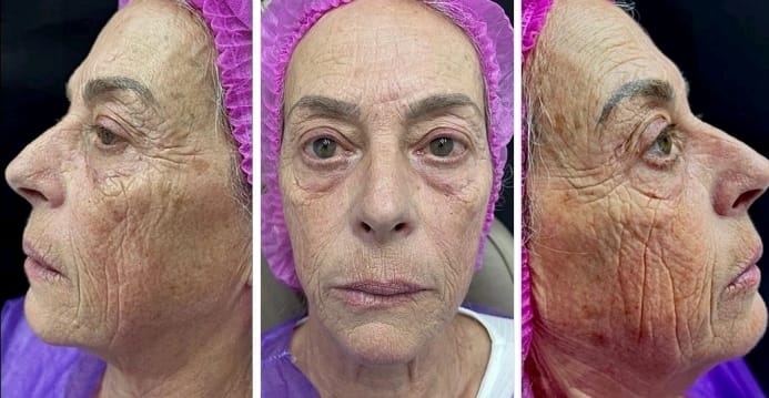 Rejuvenescimento facial — registro do rosto na Atrium Medicina