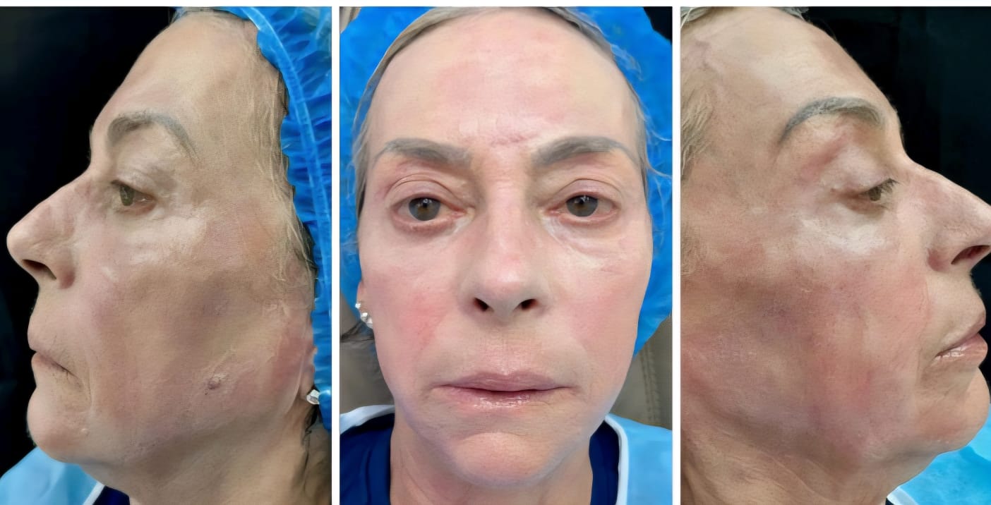 Rejuvenescimento facial — antes e depois em três ângulos na Atrium Medicina