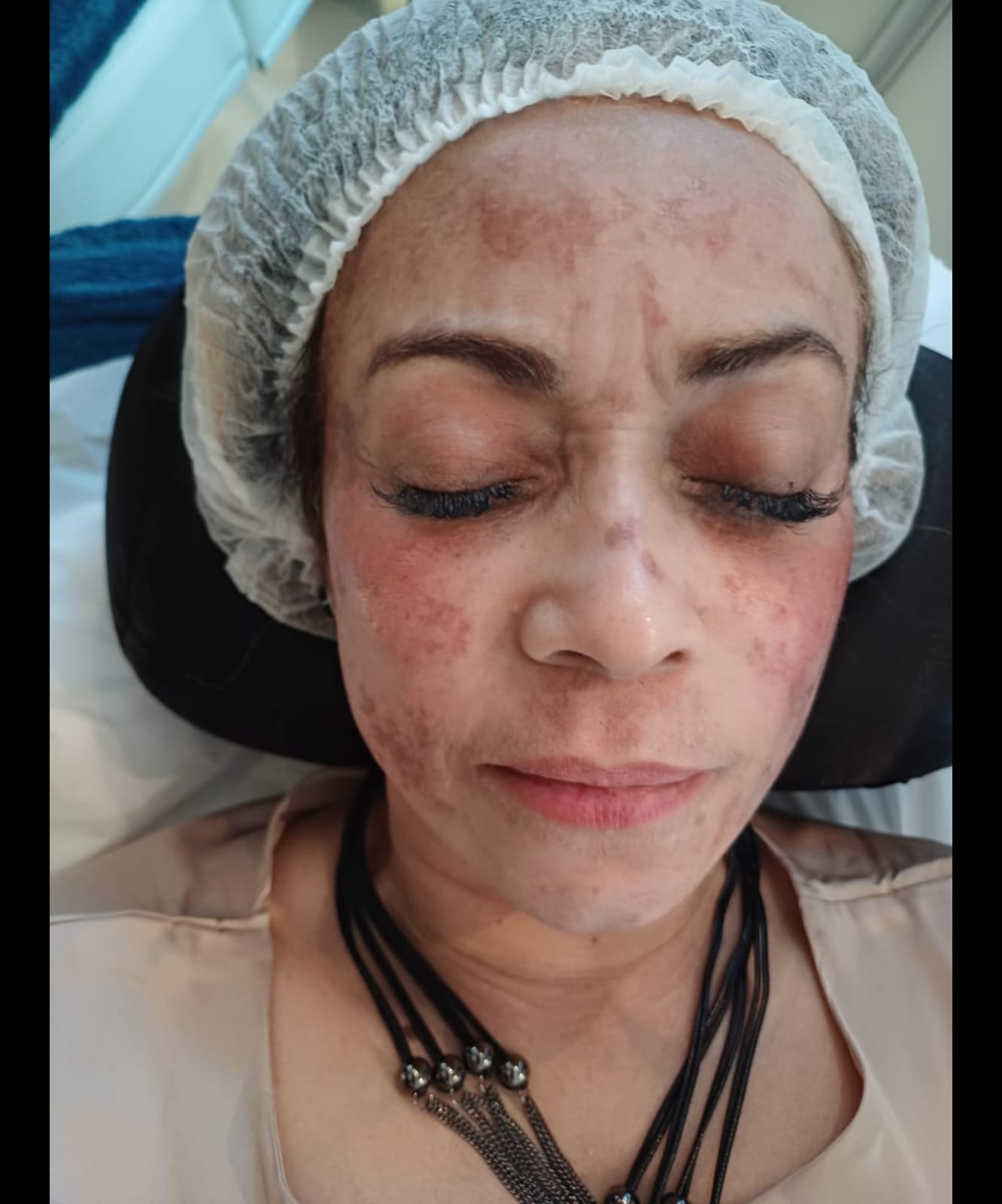 Melasma antes do tratamento na Atrium Medicina